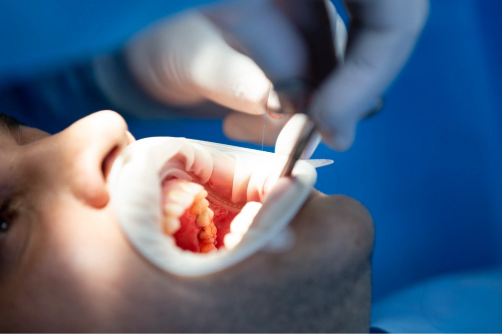 Bone Graft and Membrane: The Strong Foundation Behind Dental Implants