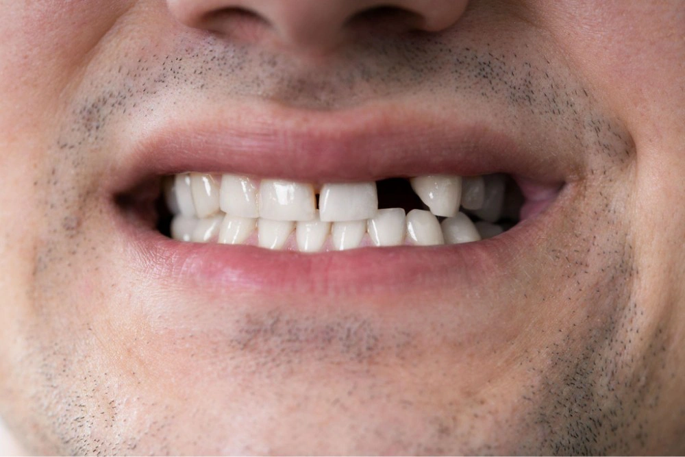 Do Not Ignore Missing Teeth: Risks and the Best Solutions