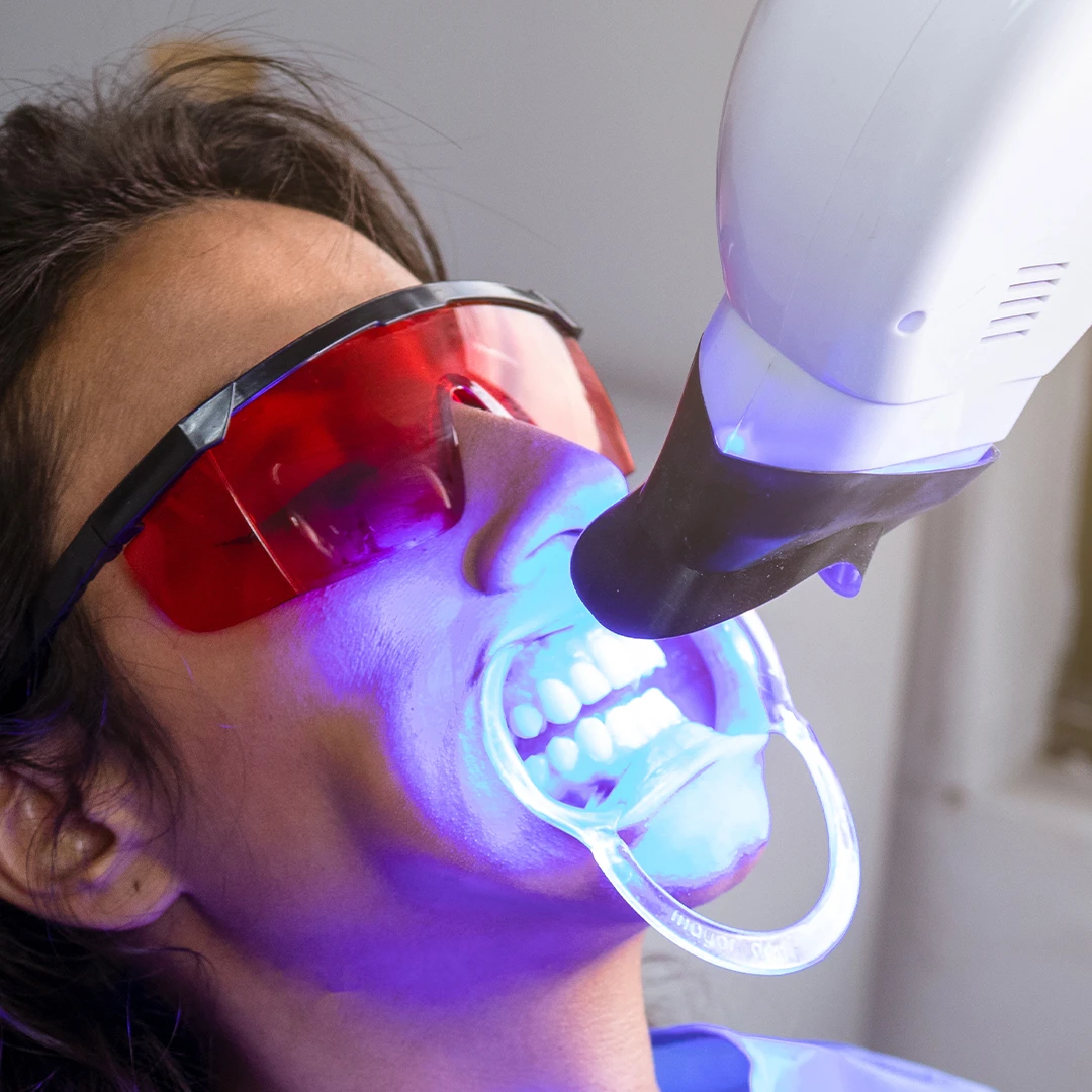 Teeth Whitening