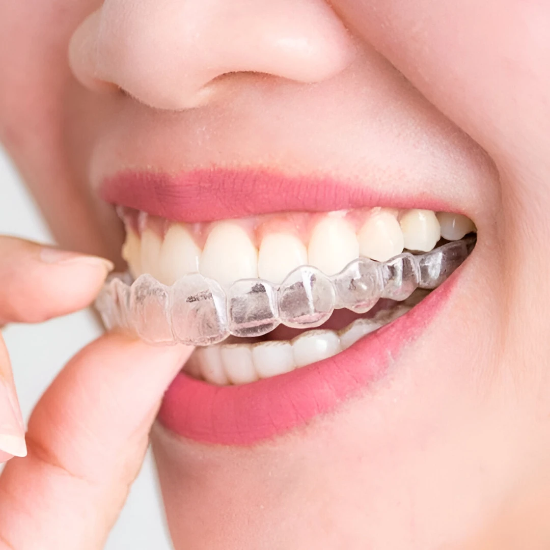Clear Aligners