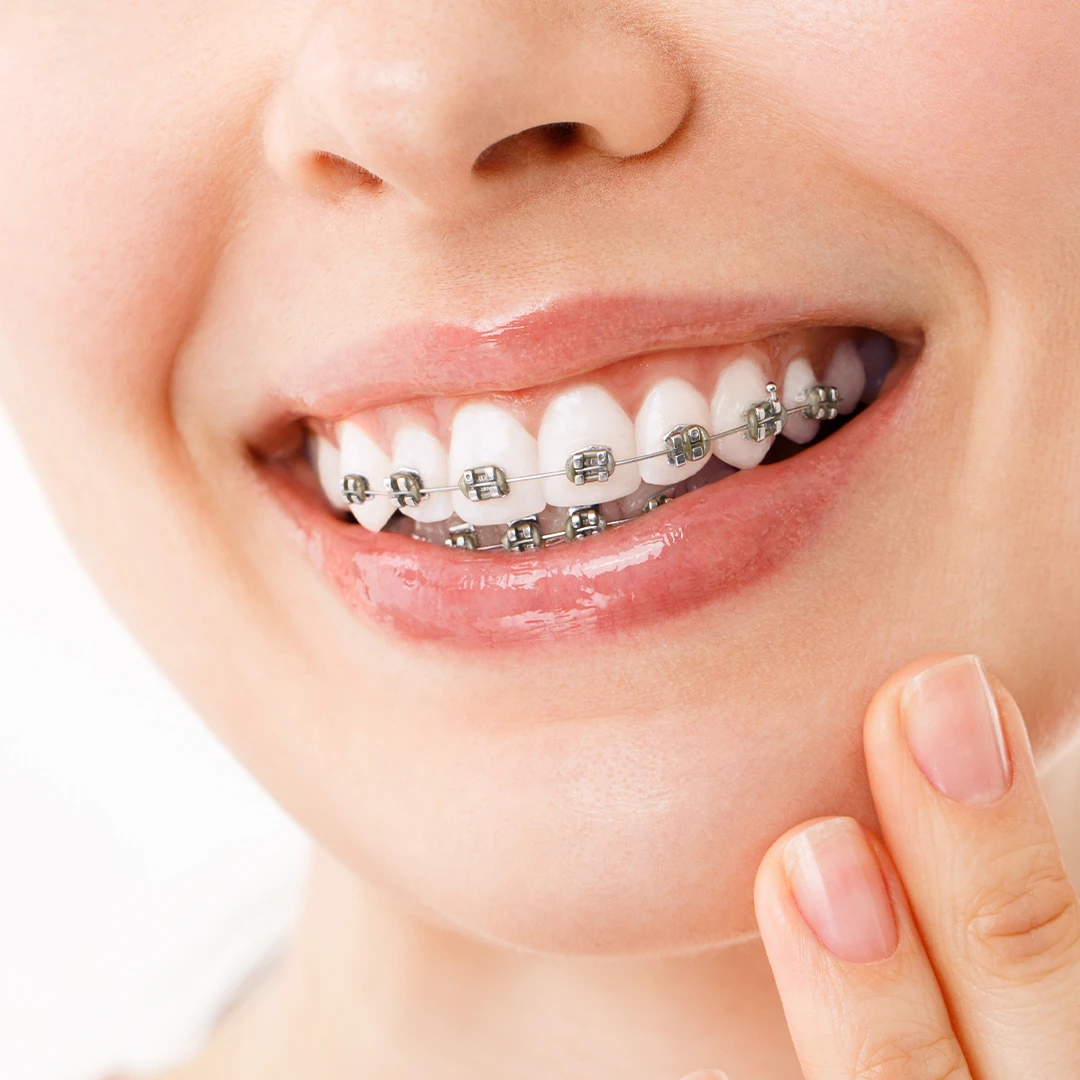 Braces